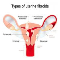 Decoding Uterus Problems: Unraveling Symptoms and Solutions