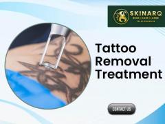 tattoo removal treatment in Pune | Best Tattoo removal treatments Specialist | Skinarq