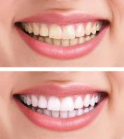 The only way to whiten your teeth without toxic chemicals 