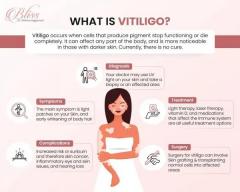 Vitiligo Treatment in Ludhiana 