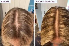 Stop Hair Thinning & Regrow Thicker, Fuller Hair In Short Time