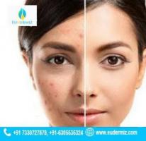 Acne & Acne Scars Treatment at Eudermiz Clinic, Hyderabad