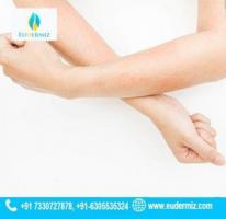 Say Goodbye to Skin Infections Trusted Care in Hyderabad