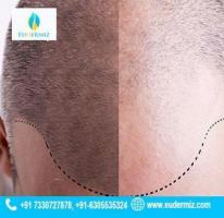 Reclaim Your Natural Hairline Hair Transplant in Hyderabad