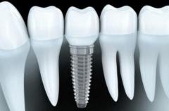 Comprehensive Dental Implants for All Teeth Solution