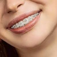 Smile Confidently with Affordable Metal Braces in Chelsea