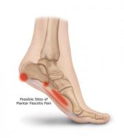 Soothing Steps: Footworks Podiatry's Approach to Plantar Fasciitis Heel Pain