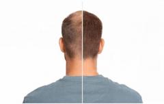 Hair Transplant Cost in Ahmedabad