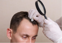 Hair Transplant Solutions in Newcastle