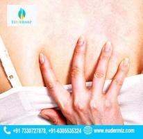 Itch Relief Top Urticaria Treatment services in Hyderabad