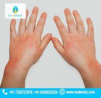 Viral Skin Infection Treatment at Eudermiz Clinic, Hyderabad
