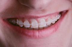 Ceramic Braces Solutions by Greater Boston Specialists