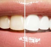Brighten Your Smile: Teeth Whitening in Mount Pleasant