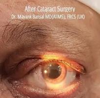 Best Cataract Surgeon in Delhi 