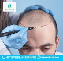 Hair Transplant Treatment in the Heart of Hyderabad