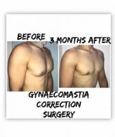 gyno surgery