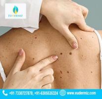 Say Goodbye to Moles: Top Clinic in Hyderabad