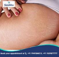 Stretch Mark Reduction Treatments at Skinbliss Clinic