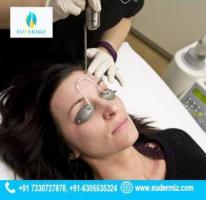 Transform Your Skin with Q-Switched Nd:YAG Laser in Hyderabad