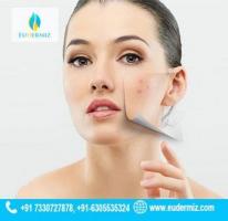 Effective Acne & Acne Scars Treatment in Hyderabad
