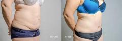 Body Contouring Surgery Clinic in Ahmedabad