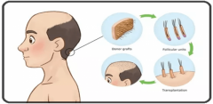 Best Clinic for Hair Loss Transplant Treatment