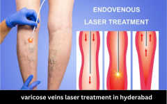 varicose veins laser treatment in hyderabad 