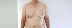 How do you know if you have Gynecomastia?