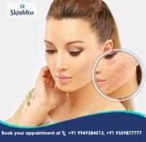 Erase Acne Scars with SkinBliss, Jubilee Hills, Hyderabad