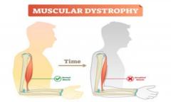Successful Treatment of Muscular Dystrophy in India - MedTravellers