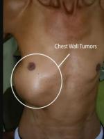 Chest wall tumor treatment in Delhi