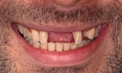 Dental Implant Cost Houston | Dental Implants Dentures