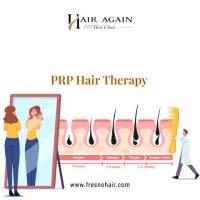 PRP Hair Therapy in Fresno