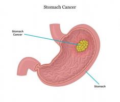 Best Stomach Cancer Treatment Hospital in Delhi | Action Cancer Hospital