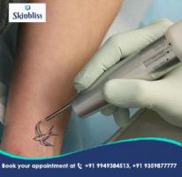 Safe & Effective Laser Tattoo Removal in Jubilee Hills, Hyderabad
