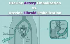 Uterine Artery Embolization vs Uterine Fibroid Embolization