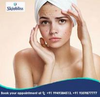 Effective Acne Scars Treatment in Jubilee Hills, Hyderabad